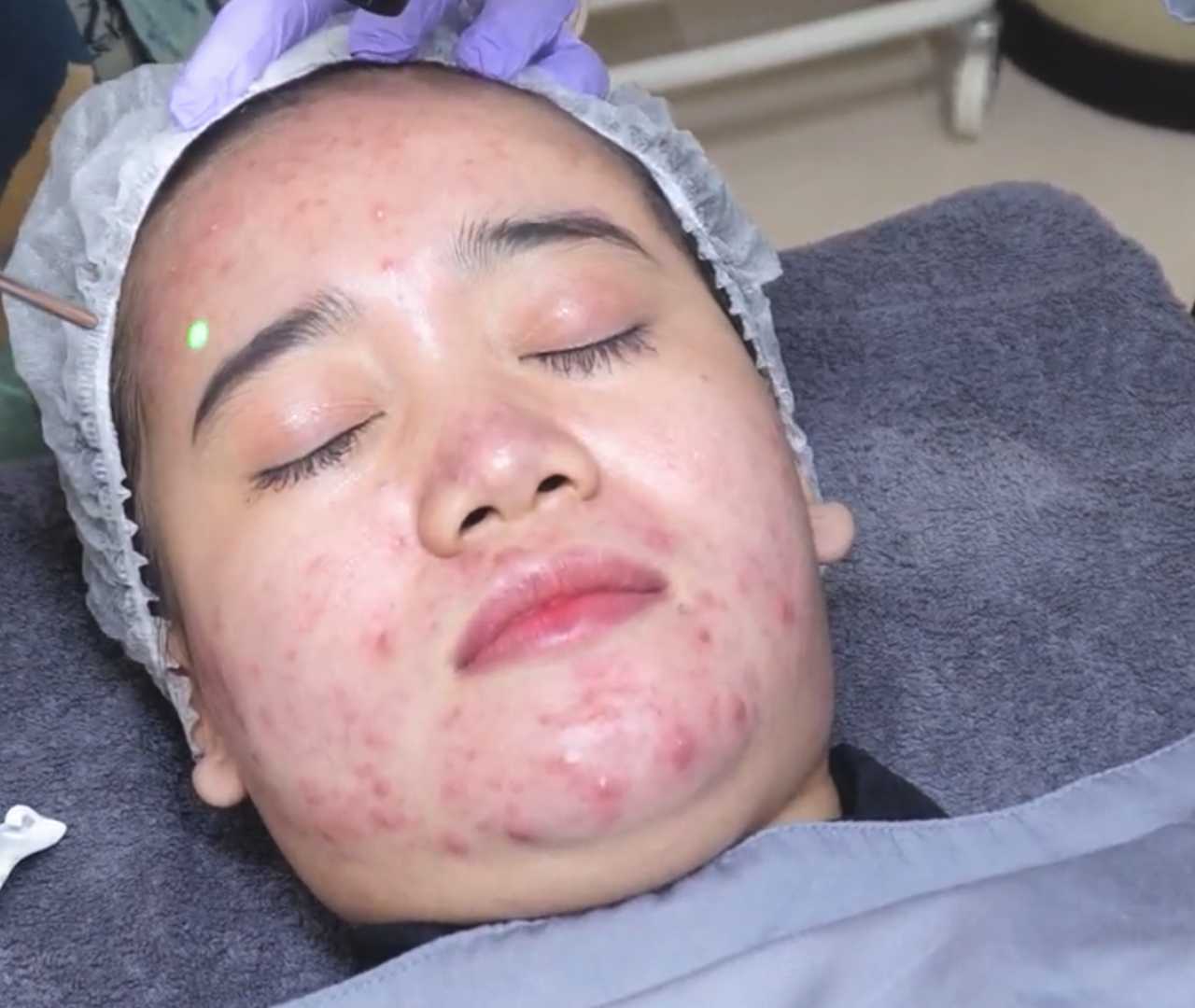Acne Scars