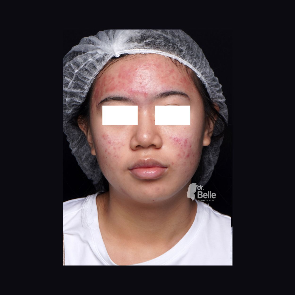 Before treatment pasien 1