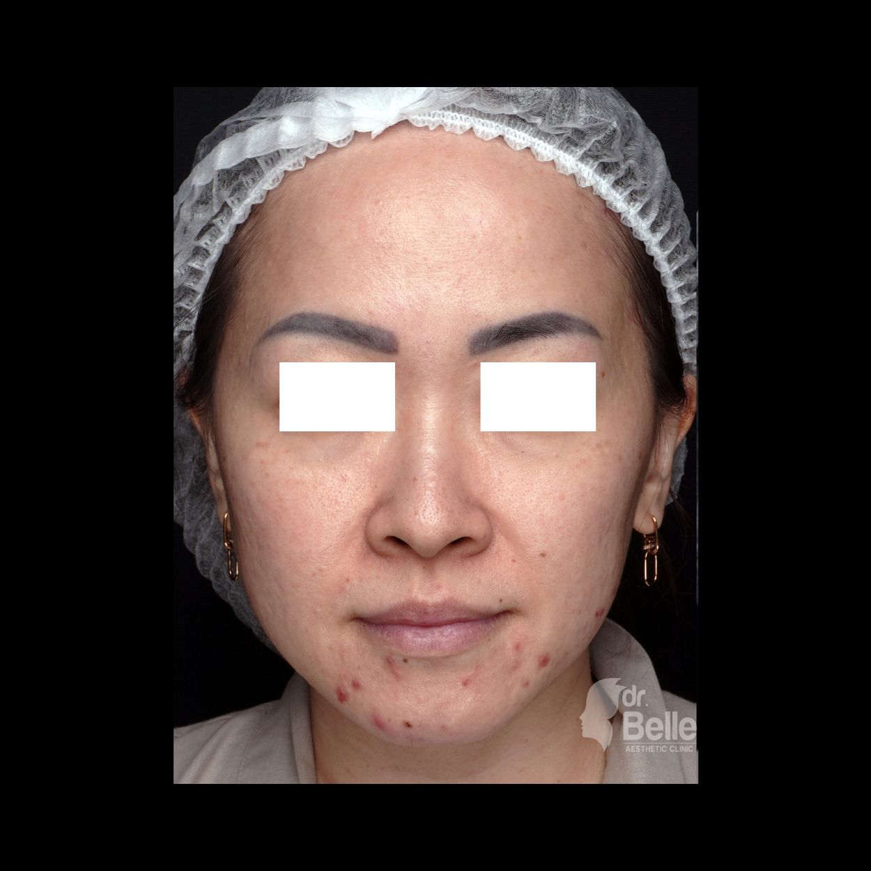 Before treatment pasien 2